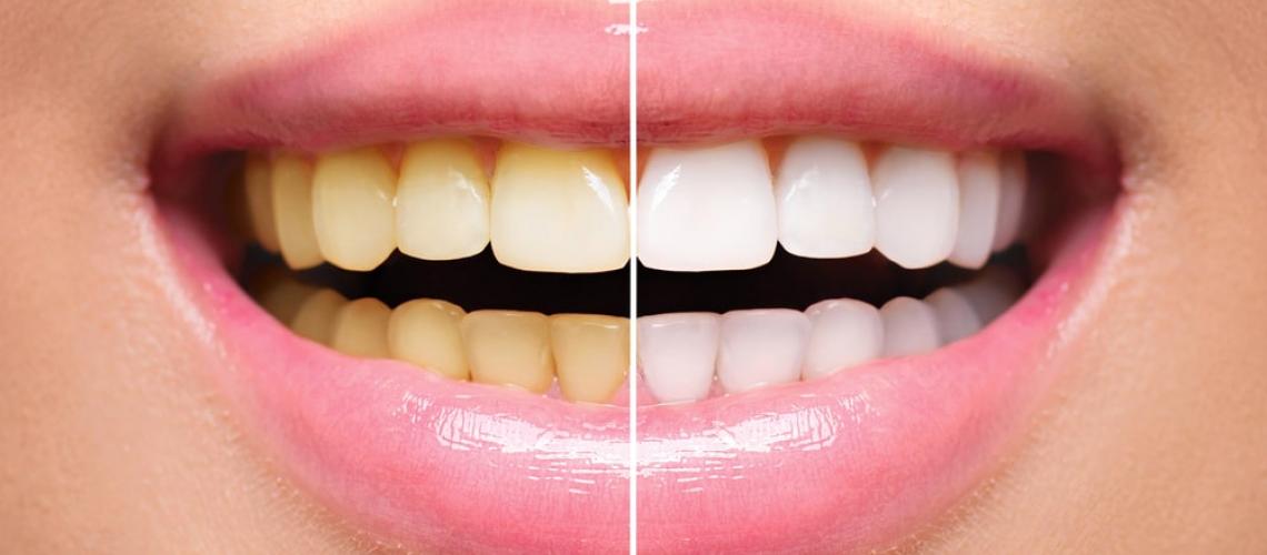 Sorriso com metade dos dentes amarelos, e metade dos dentes brancos