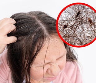 Mulher coçando a cabeça, com um close-up ampliado no canto superior direito mostrando piolhos e lêndeas no cabelo, ilustrando a pediculose.